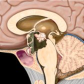 Sagittal graphic shows a predominantly cystic, partially solid, suprasellar mass with focal rim Ca⁺⁺. Note the small intrasellar component and fluid-fluid level. Craniopharyngiomas are the 90% tumors (90% cystic, 90% Ca⁺⁺, and 90% enhancing).