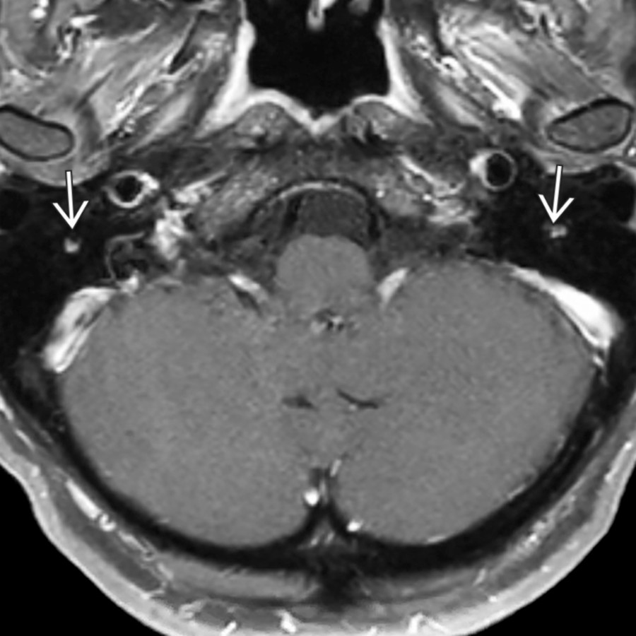 Axial MR in the same patient shows moderate, normal linear enhancement of the lower mastoid segments
of the facial nerves. Contrast enhancement of mastoid segment CNVII is usually more robust distally.