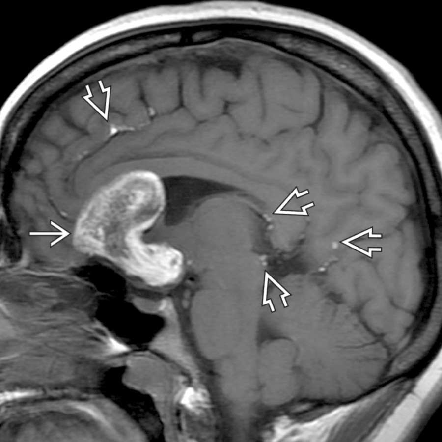 Sagittal T1 MR shows a large midline mass with intrinsic T1 shortening within the subfrontal region above the optic chiasm along the 3rd ventricular floor
. T1-hyperintense "droplets" are seen scattered throughout the subarachnoid space
related to a ruptured dermoid.