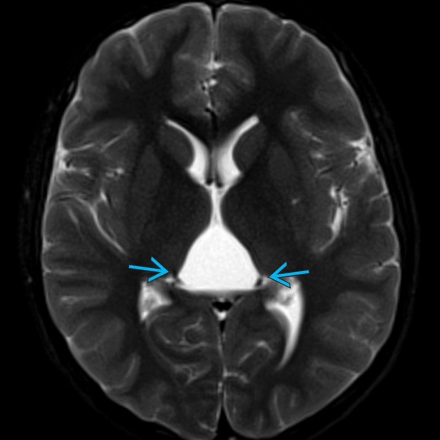 Axial T2WI FS MR shows a cyst between the thalami and splaying the internal cerebral veins
. Cysts of the cavum velum interpositum arise superior to the quadrigeminal cistern, but very large cysts may extend into or efface the quadrigeminal cistern.