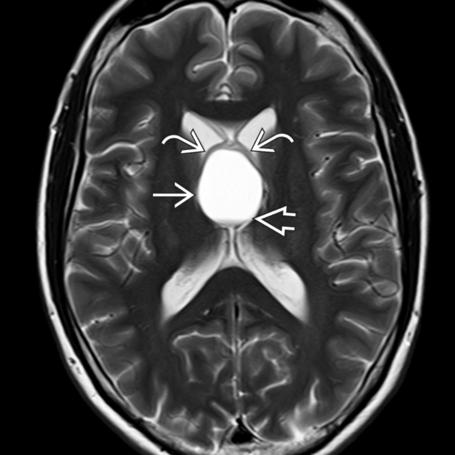 Axial T2WI MR in the same patient shows the mass
is cystic and even more hyperintense than cerebrospinal fluid (CSF) in the adjacent ventricles. Note the blood-fluid level
and splaying of the fornices
around the mass.