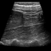 Longitudinal grayscale ultrasound at the level of the lower pole of the right kidney shows the psoas and oblique muscles.
