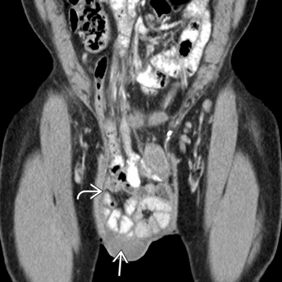 Coronal CECT demonstrates a large right inguinal hernia
in a patient who reported a long history of a growing bulge in the groin. The hernia contains multiple small bowel loops, portions of the colon, and small ascites
.