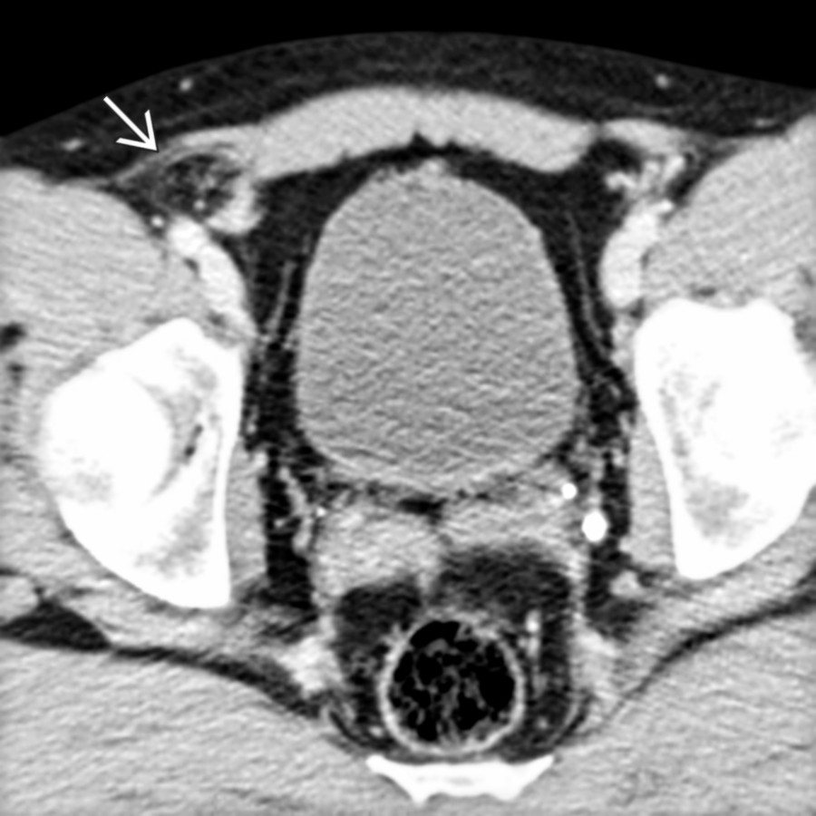 Axial CECT at a higher level in the same patient demonstrates abdominal wall defect
.