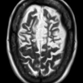 Axial T2WI MR in a patient with FTD shows marked frontal lobe atrophy.