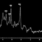 MRS spectrum in the parietal lobe of a patient with probable AD shows decreased N-acetyl aspartate level (neuronal loss) and elevated myoinositol level (gliosis). (Courtesy J. Norfray, MD.)