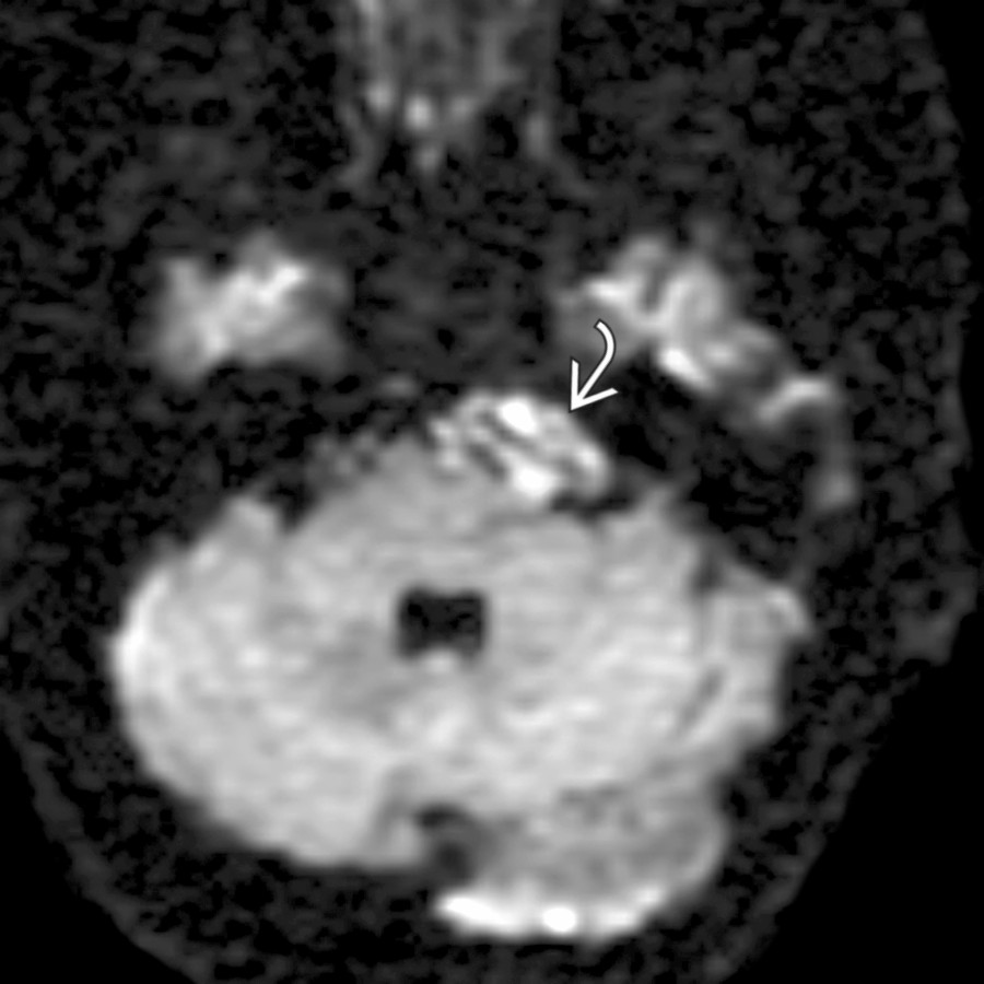 Axial DWI MR shows a CPA epidermoid identified by its reduced diffusivity
. CPA epidermoids often are not directly over the porus acusticus, as in this case.