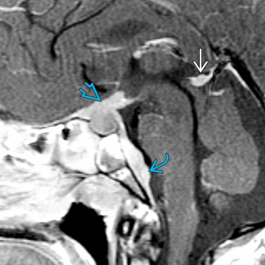 Sagittal T1 C+ MR shows an enhancing mass in the suprasellar region that extends into the pituitary infundibulum
as well as along the dura of the posterior clivus
. Primary lymphoma was found at biopsy. Note prominent enhancement of the pineal gland
.