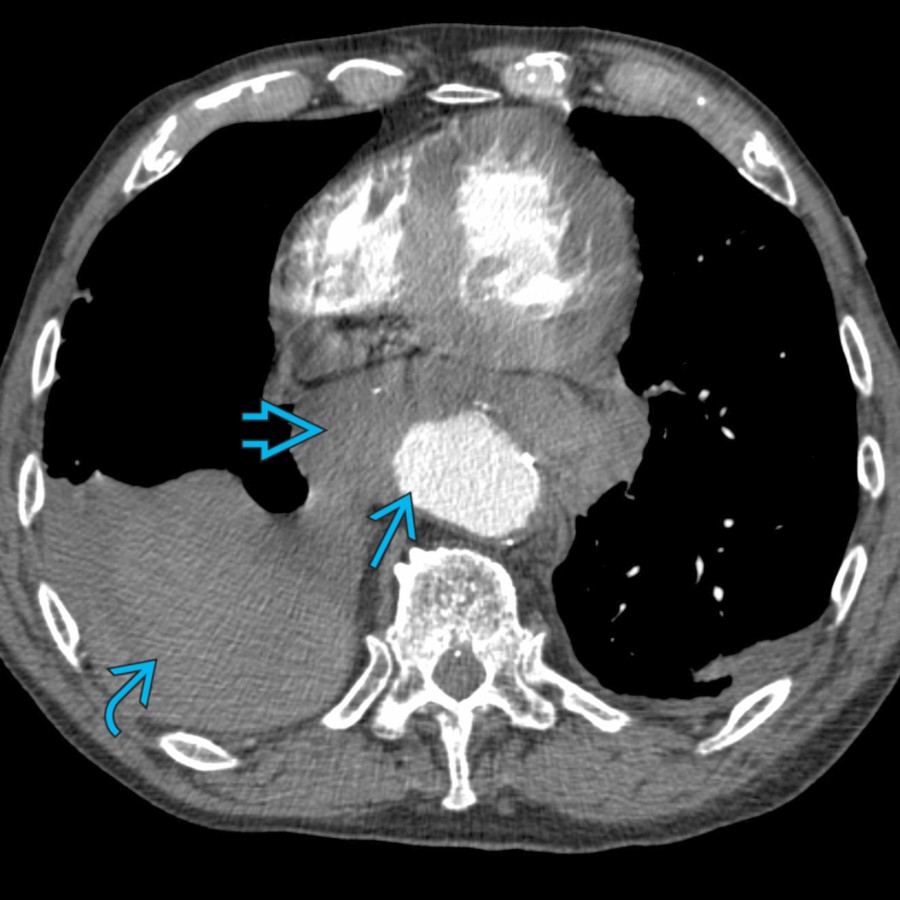 Axial CT in an 83-year-old man with severe chest pain shows a thoracic aortic aneurysm with mild irregularity of the right wall
with surrounding mediastinal hematoma
and large right hemothorax
. Rupture was confirmed surgically.