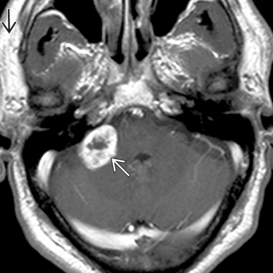 Axial T1 C+ MR reveals an enhancing CPA mass
, with intramural cysts, which projected into the IAC but did not involve the labyrinthine segment. Note atrophy of the right platysma muscle
from CNVII denervation.