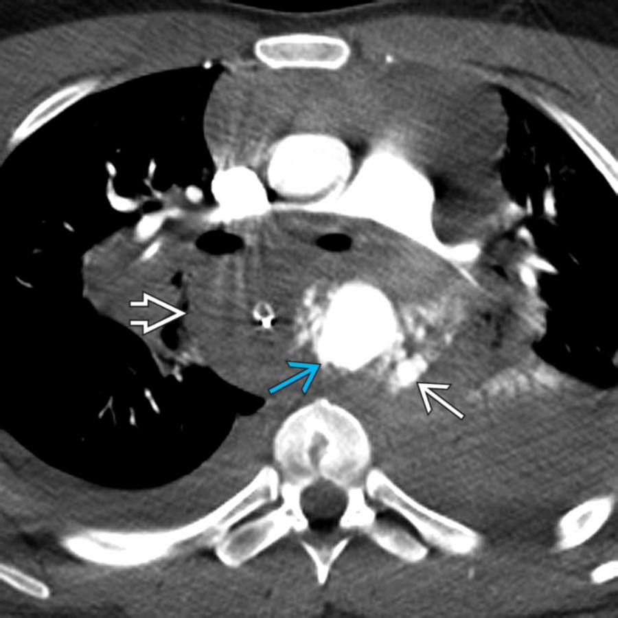 Axial CTA in the same patient shows active contrast extravasation
from the ruptured descending aorta
and a large mediastinal hematoma
that produces mass effect on the esophagus, airways, and pulmonary arteries.