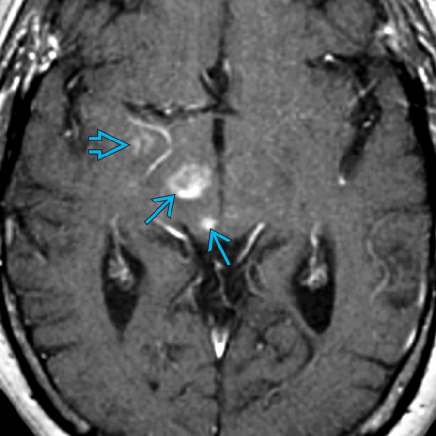 Axial T1 C+ MR in the same patient shows patchy enhancement of the midbrain lesions
and the medial temporal lobe
. This patient was diagnosed with LE with new brainstem symptoms. Multiple paraneoplastic syndromes may occur in the same patient.