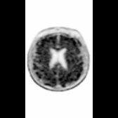 Axial F-18 florbetapir at the level of the lateral ventricles in a patient with lvPPA demonstrates diffuse radiotracer uptake throughout the supratentorial gray matter
, consistent with moderate to frequent amyloid neuritic plaques.
