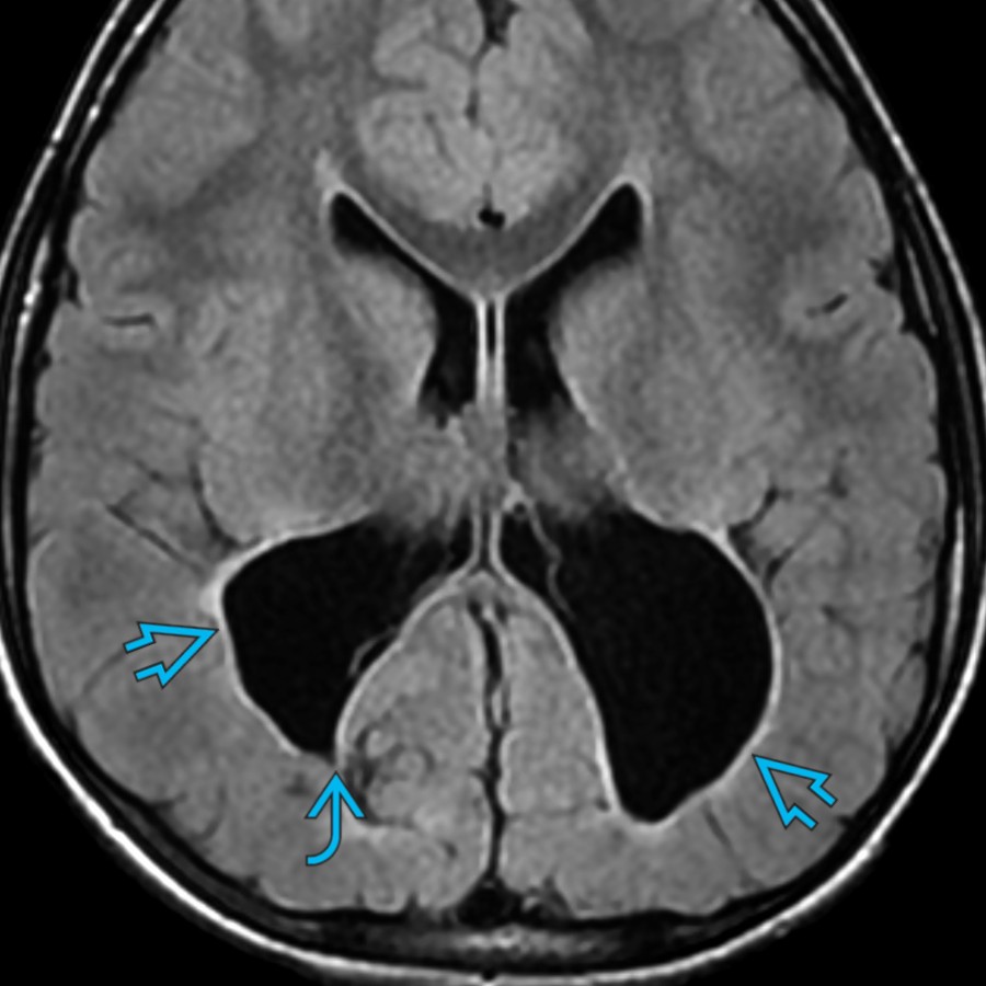 Axial FLAIR MR in a 7 year old with a history of prematurity & periventricular leukomalacia (PVL) shows severe WM volume loss
with relatively little signal abnormality. Also note the angular margins
of the expanded ventricular occipital horns, consistent with PVL related to extreme prematurity.