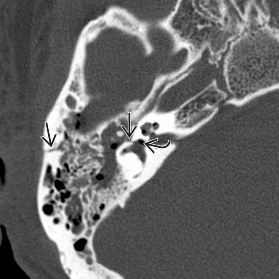 Axial bone CT shows longitudinal temporal bone fracture
with associated pneumolabyrinth
.