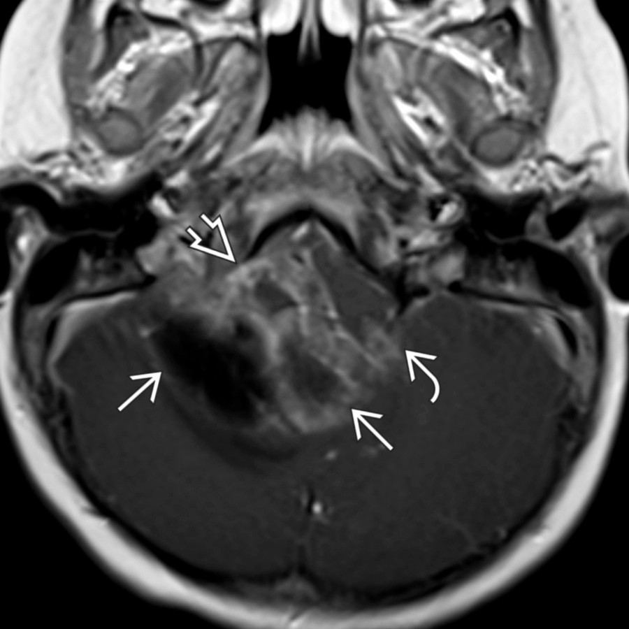 Axial T1 C+ MR in a 2-year-old child demonstrates a large, heterogeneously enhancing posterior fossa mass
filling the 4th ventricle, extending through the foramen of Luschka and into the right CPA cistern
. Notice extension across the midline toward the left foramen of Luschka
.