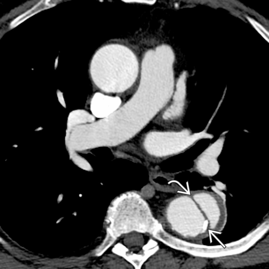 Axial CECT shows a dissection flap
in the descending aorta with a displaced intimal calcification
. The dissection did not involve the arch and was managed medically.
