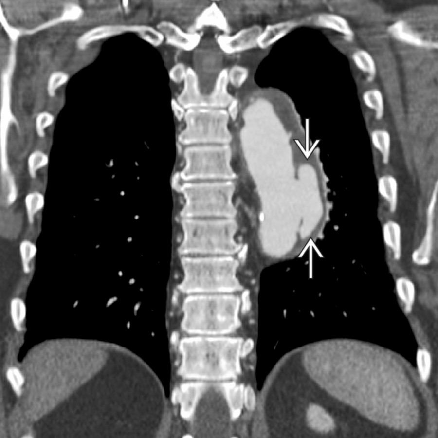 Coronal CECT shows pseudoaneurysm in the mid descending aorta
thought to be a mycotic aneurysm. Aside from this aneurysm, there was a paucity of disease throughout the remaining aorta.