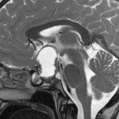 Sagittal T2 MR in a 9 year old with headache and visual changes shows a heterogeneous cystic and solid sellar and suprasellar craniopharyngioma
with anterior extension into the sphenoid sinus
and superior displacement of the optic chiasm.