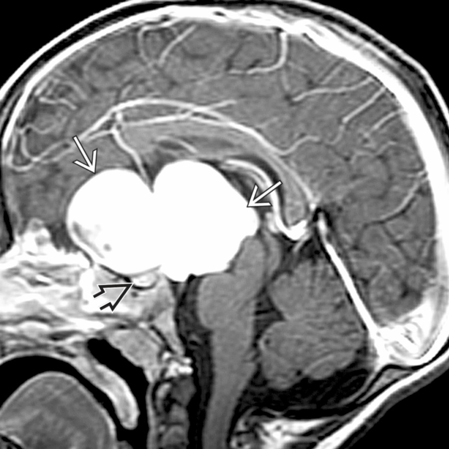 Sagittal T1 C+ MR in a 3-year-old boy with rotary nystagmus and vomiting shows a large suprasellar mass
clearly separate from the pituitary gland below
.