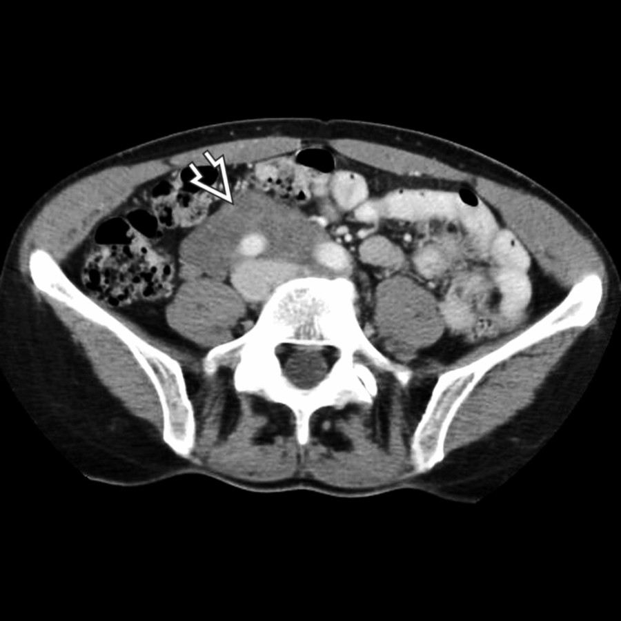 Axial CECT shows a soft tissue mass
that extends along the aorta, IVC, and right psoas. Biopsy showed ganglioneuroma arising from the sympathetic neural chain.
