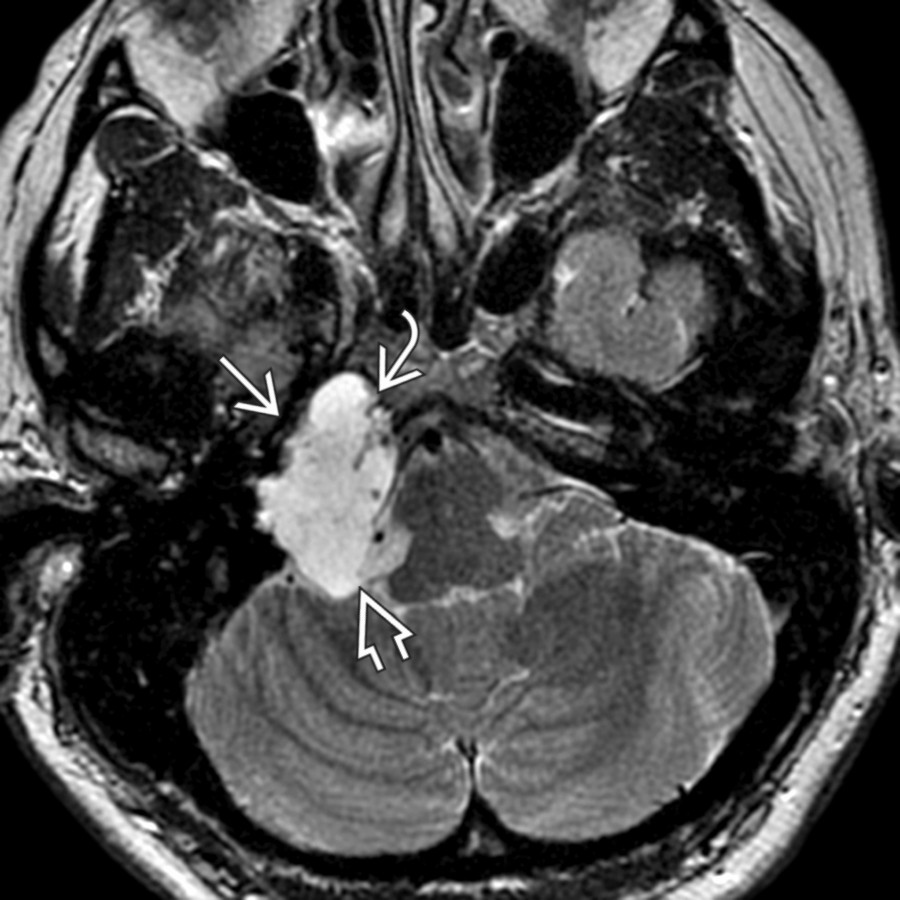Axial T2 MR shows a hyperintense chondrosarcoma involving the right petrous apex
and extending into the right cerebellopontine angle cistern (CPA)
. The petrous carotid artery is displaced anteriorly
.