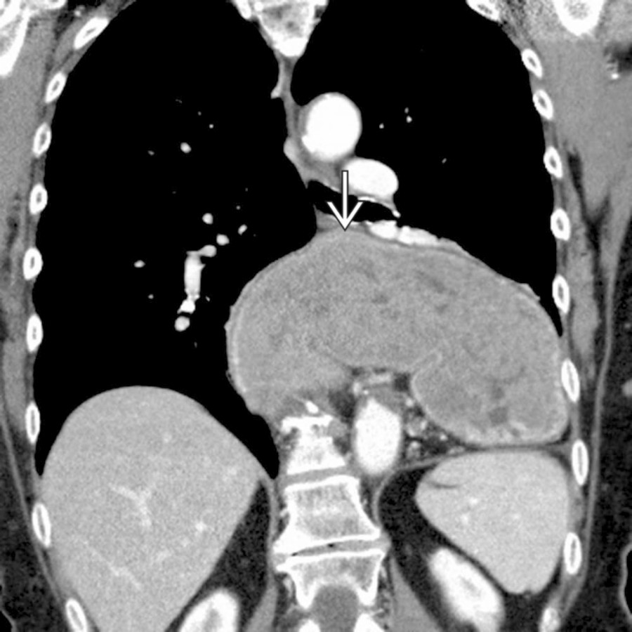 Coronal CECT shows a large hiatal hernia with the entirety of the stomach
located within the thoracic cavity.