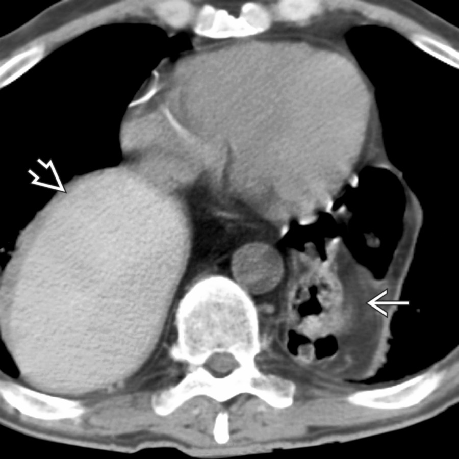 Axial NECT shows herniation of most of the stomach
as well as the splenic flexure of colon
through a massive hiatal hernia.