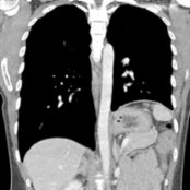Coronal CECT shows marked asymmetric elevation of the left hemidiaphragm. In this case, the left diaphragm
is paralyzed due to phrenic nerve involvement by the patient's mediastinal lymphoma (not shown).
