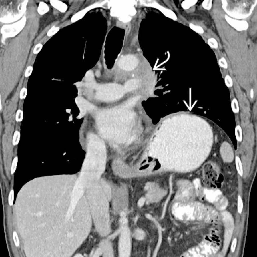 Coronal CECT shows marked asymmetric elevation of the left hemidiaphragm. In this case, the left diaphragm
is paralyzed as a result of phrenic nerve involvement by a mediastinal soft tissue mass
in this patient with metastatic lung cancer.